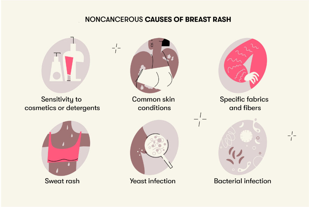 Inflammatory Breast Cancer How To Spot It And What To Do About It inflammatory-breast-cancer-how-to-spot-it-and-what-to-do-about-it